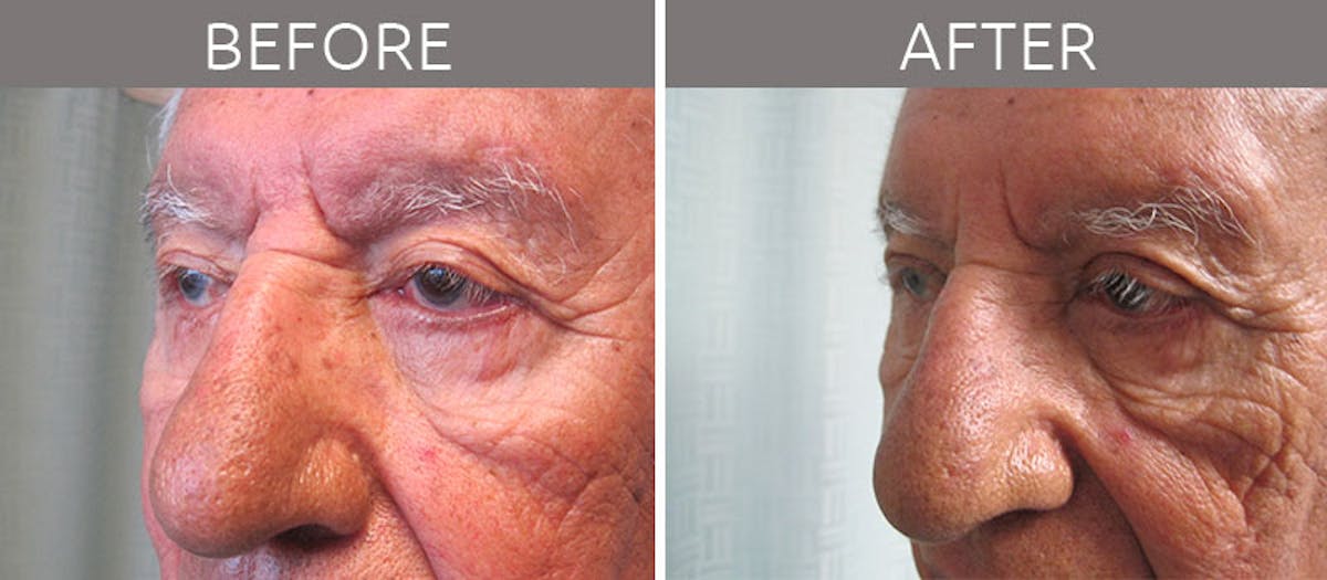 Blepharoplasty Before & After Gallery - Patient 90709203 - Image 4