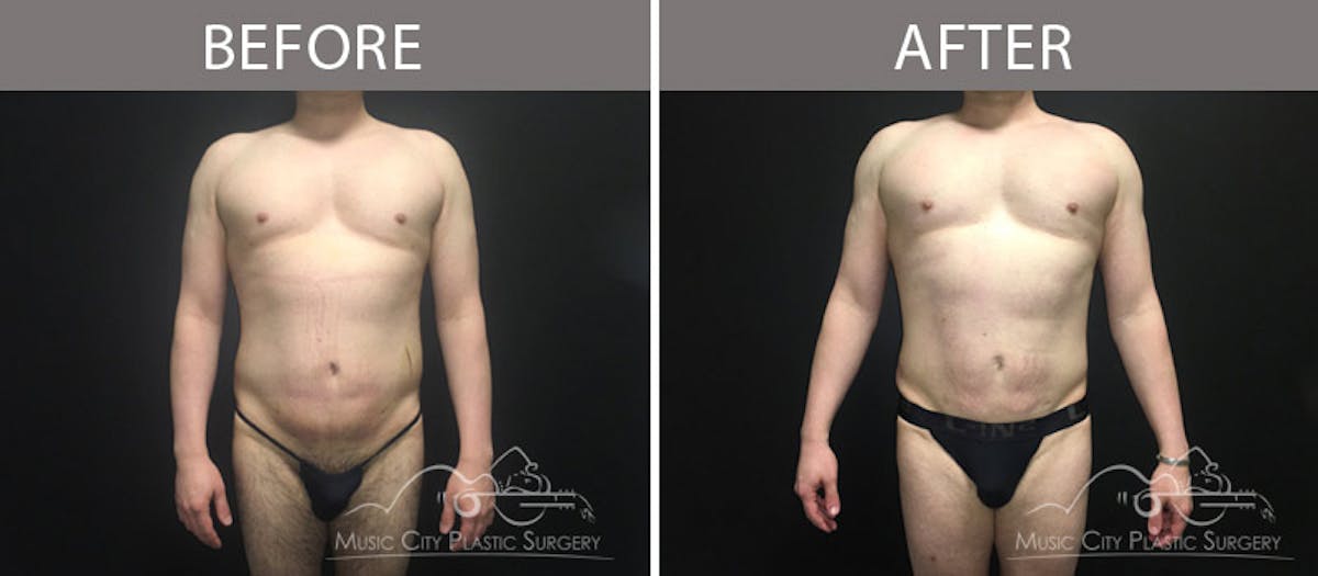 Male Liposuction Before & After Gallery - Patient 90709202 - Image 1