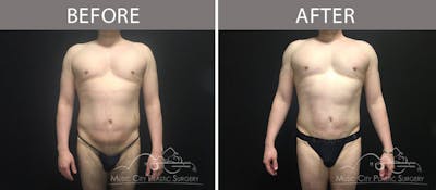 Male Liposuction Before & After Gallery - Patient 90709202 - Image 1