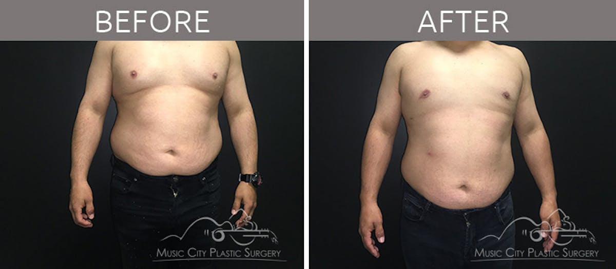 Gynecomastia Before & After Gallery - Patient 90709204 - Image 2