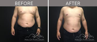 Gynecomastia Before & After Gallery - Patient 90709204 - Image 2