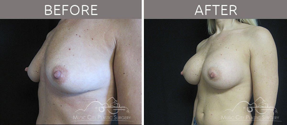 Breast Augmentation Before & After Gallery - Patient 90709207 - Image 2