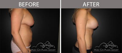 Mommy Makeover Before & After Gallery - Patient 90709210 - Image 3