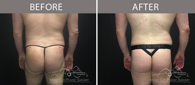 Liposuction Before & After Gallery - Patient 90709202 - Image 2