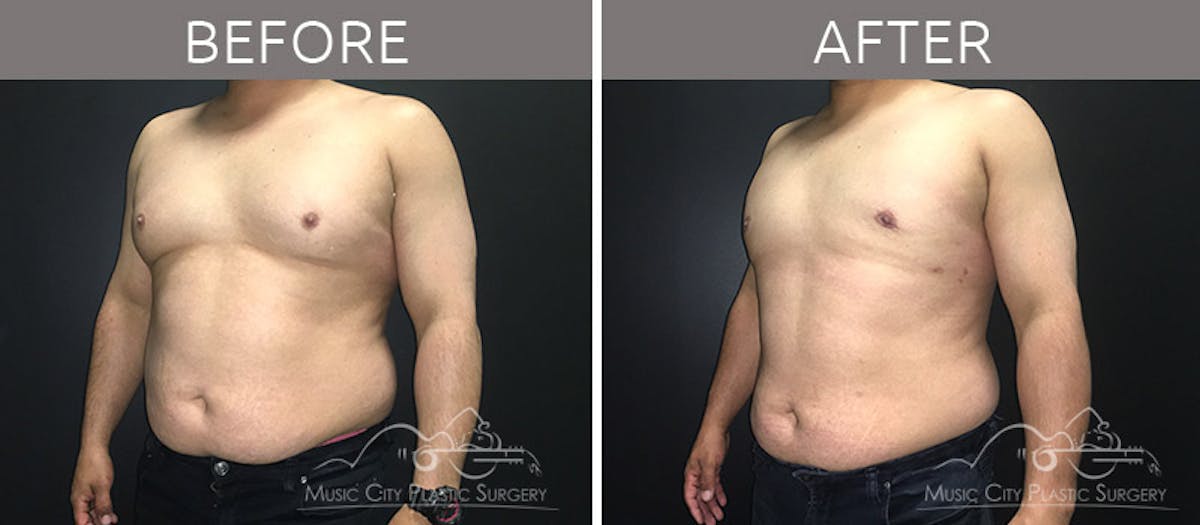 Gynecomastia Before & After Gallery - Patient 90709204 - Image 3