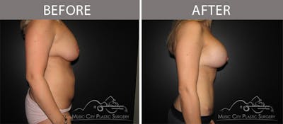 Breast Lift with Augmentation Before & After Gallery - Patient 132099612 - Image 3