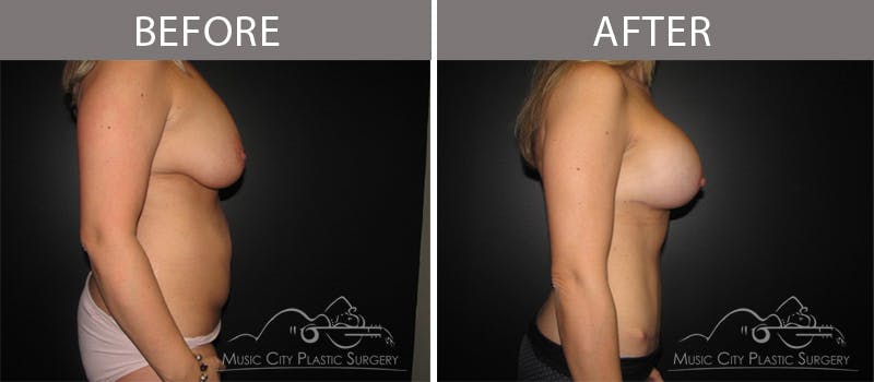 Breast Lift with Augmentation Before & After Gallery - Patient 132099612 - Image 3