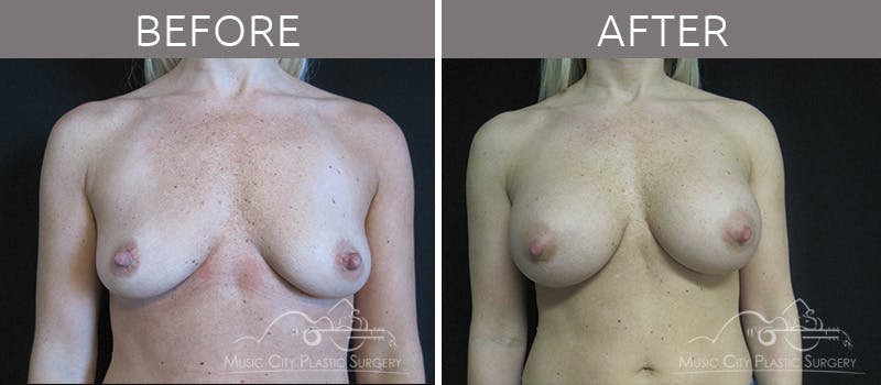 Breast Augmentation Before & After Gallery - Patient 90709207 - Image 1