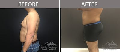 Male Liposuction Before & After Gallery - Patient 90709208 - Image 1