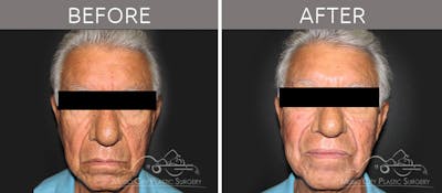 Dermal Fillers Before & After Gallery - Patient 90709206 - Image 1