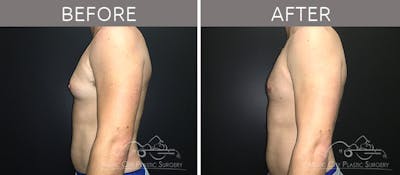 Gynecomastia Before & After Gallery - Patient 90709211 - Image 1