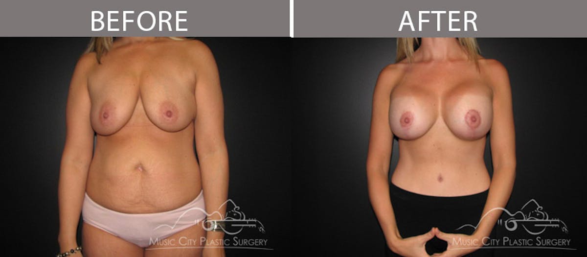 Mommy Makeover Before & After Gallery - Patient 90709210 - Image 5