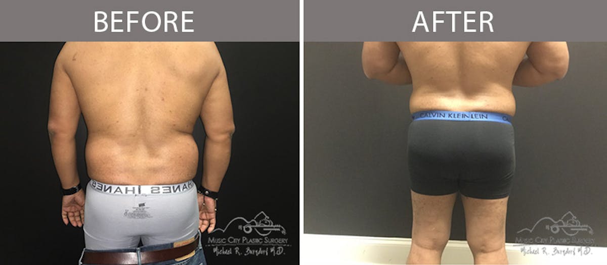 Male Liposuction Before & After Gallery - Patient 90709208 - Image 2