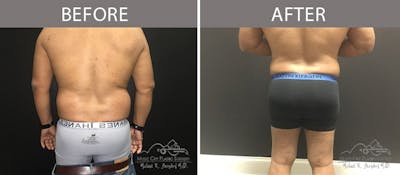 Liposuction Before & After Gallery - Patient 90709208 - Image 2