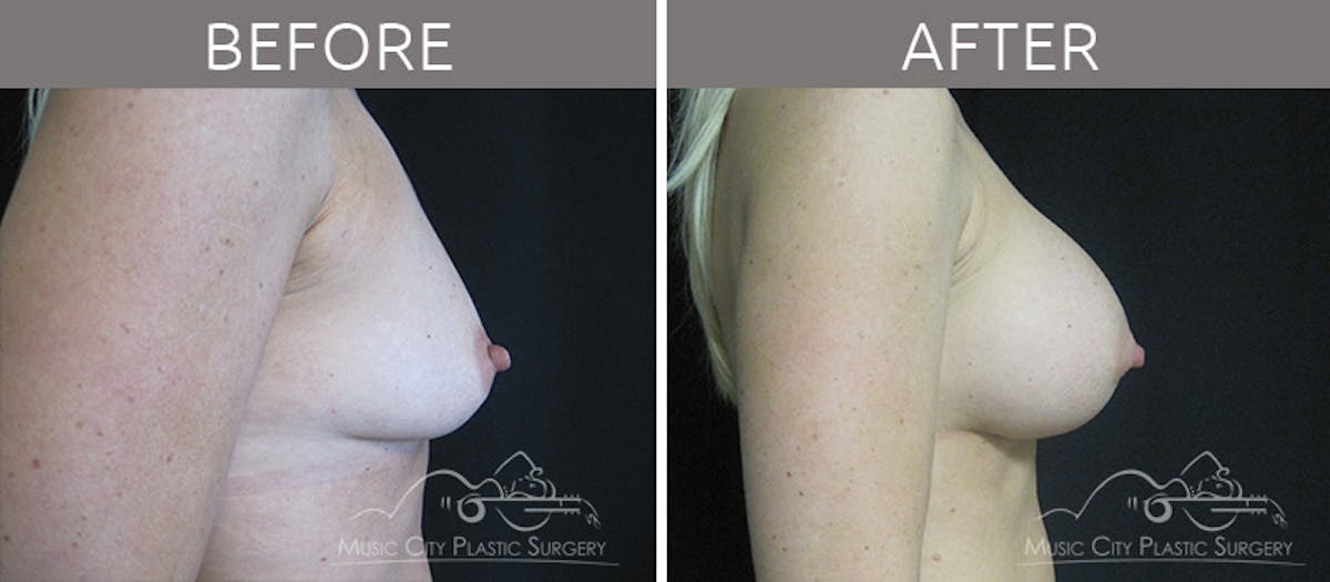 Breast Augmentation Before & After Gallery - Patient 90709207 - Image 3