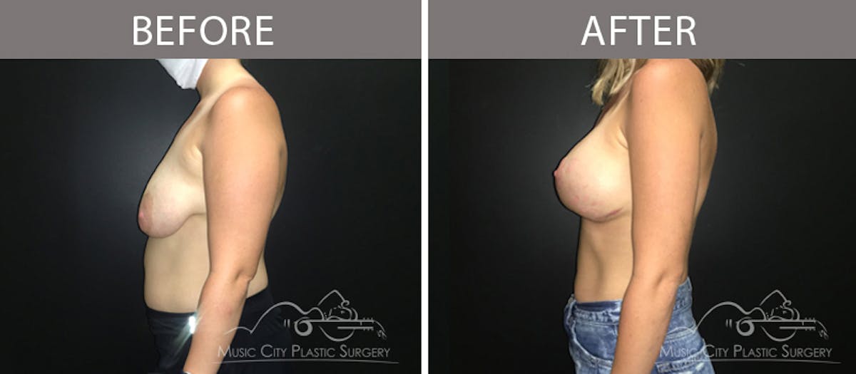 Breast Lift Before & After Gallery - Patient 90709212 - Image 3