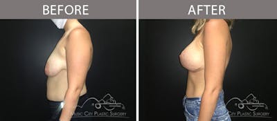 Breast Lift Before & After Gallery - Patient 90709212 - Image 3
