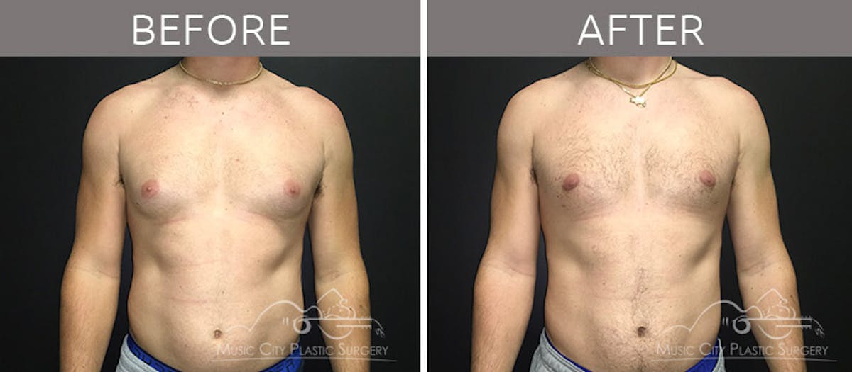 Gynecomastia Before & After Gallery - Patient 90709211 - Image 2
