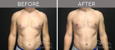 Gynecomastia Before & After Gallery - Patient 90709211 - Image 2