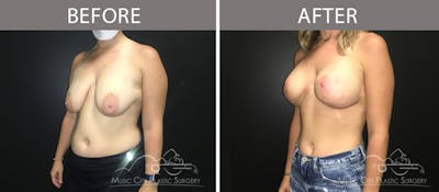 Breast Lift Before & After Gallery - Patient 90709212 - Image 2