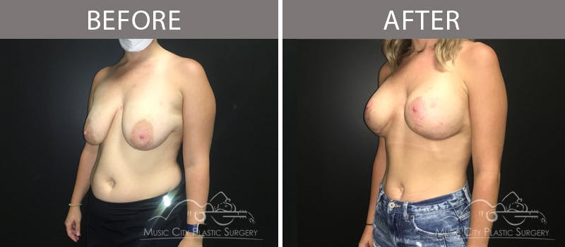 Breast Lift Before & After Gallery - Patient 90709212 - Image 2