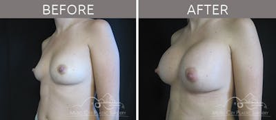 Breast Augmentation Before & After Gallery - Patient 90709213 - Image 2