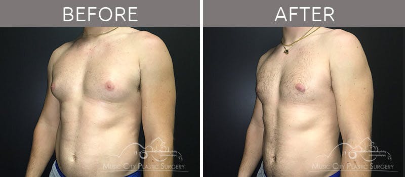 Gynecomastia Before & After Gallery - Patient 90709211 - Image 3