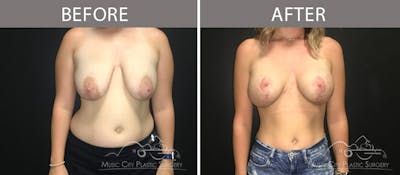 Breast Lift Before & After Gallery - Patient 90709212 - Image 1