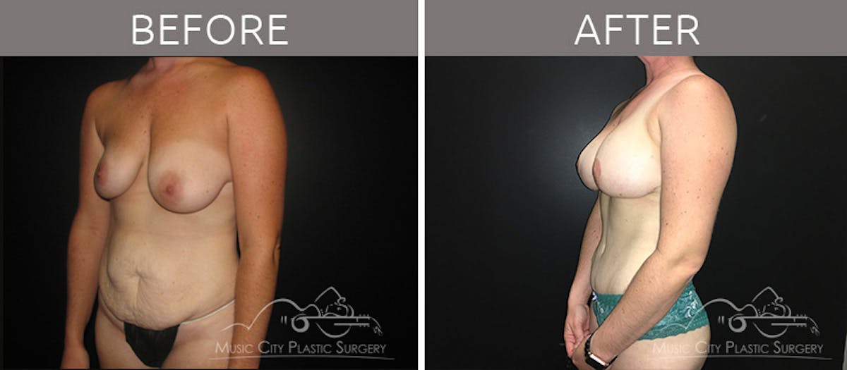 Mommy Makeover Before & After Gallery - Patient 90709215 - Image 2