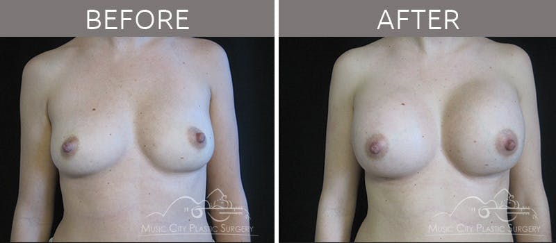 Breast Augmentation Before & After Gallery - Patient 90709213 - Image 2