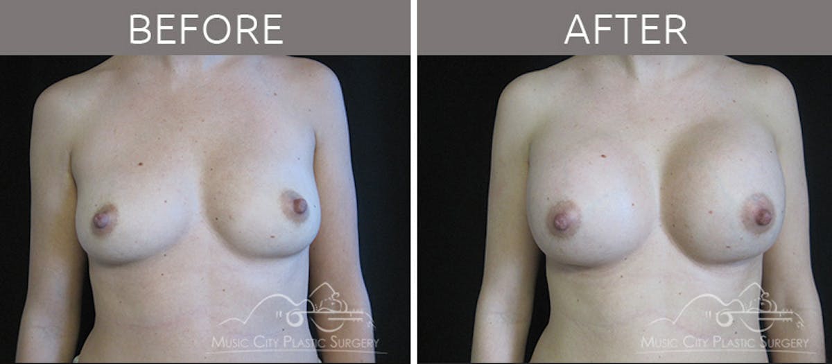 Breast Augmentation Before & After Gallery - Patient 90709213 - Image 1