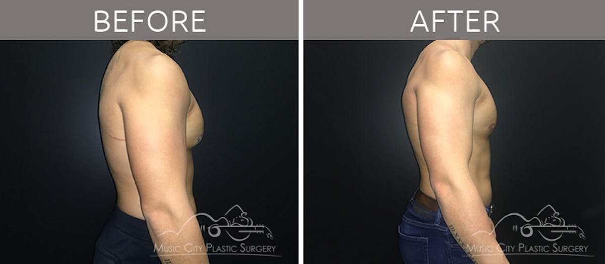 Gynecomastia Before & After Gallery - Patient 90709214 - Image 1