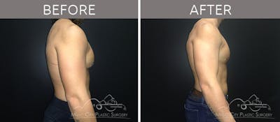 Gynecomastia Before & After Gallery - Patient 90709214 - Image 1