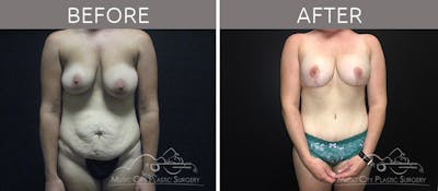 Mommy Makeover Before & After Gallery - Patient 90709215 - Image 1