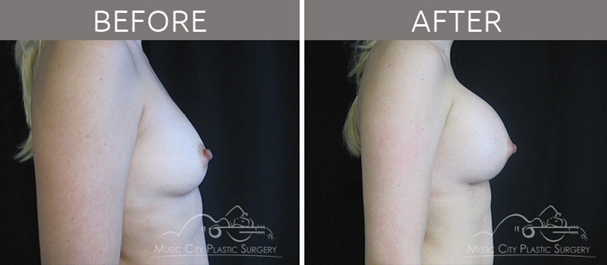 Breast Augmentation Before & After Gallery - Patient 90709213 - Image 3