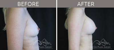 Breast Augmentation Before & After Gallery - Patient 90709213 - Image 3