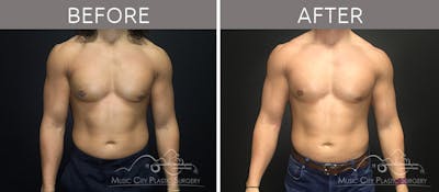 Gynecomastia Before & After Gallery - Patient 90709214 - Image 2