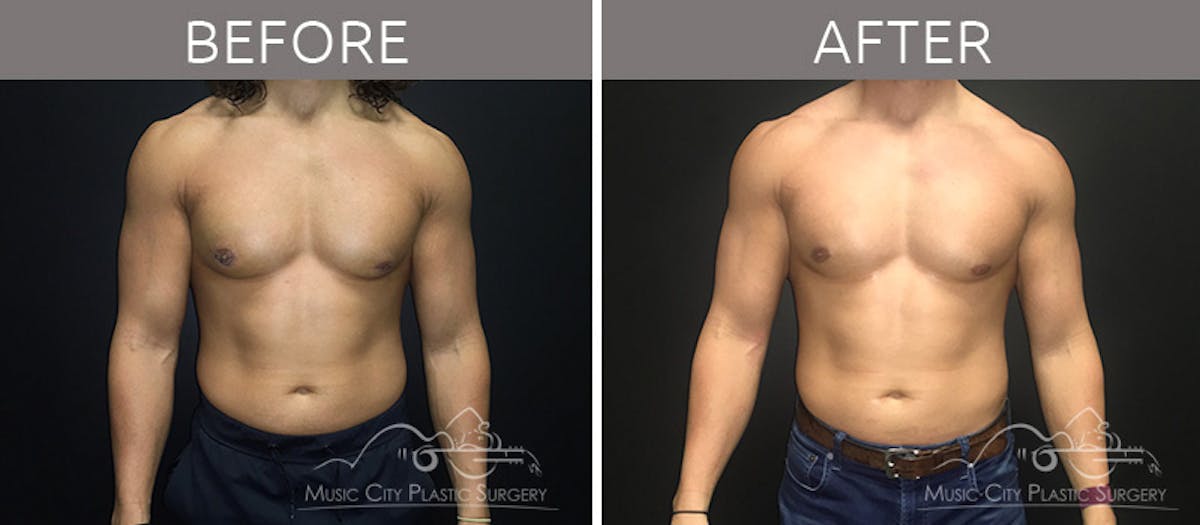 Gynecomastia Before & After Gallery - Patient 90709214 - Image 2