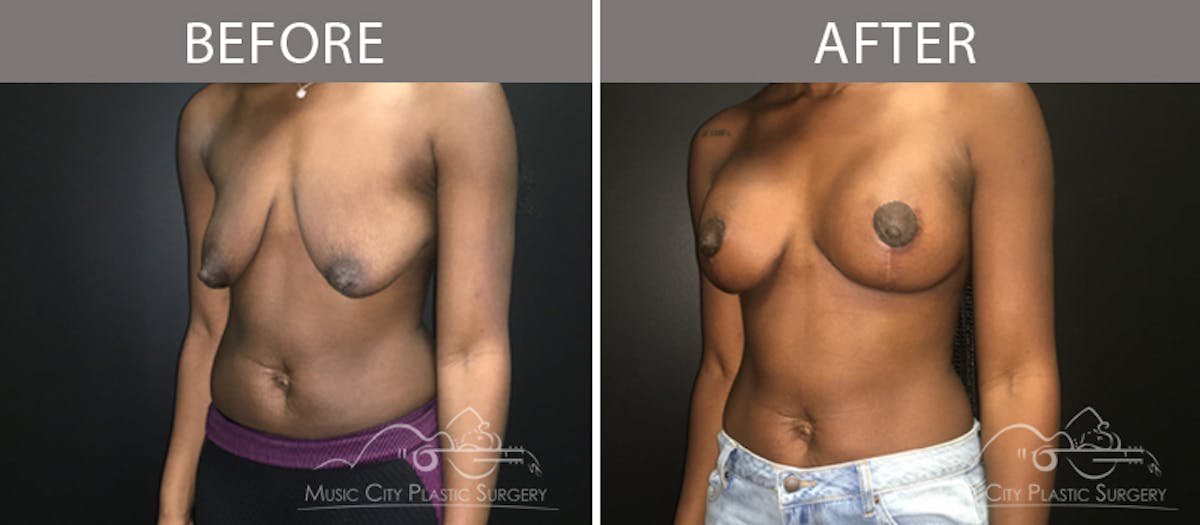 Breast Lift with Augmentation Before & After Gallery - Patient 132099620 - Image 2