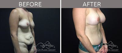 Mommy Makeover Before & After Gallery - Patient 90709215 - Image 3