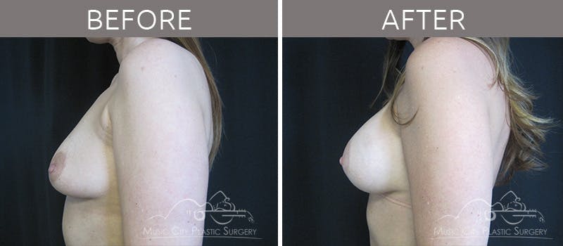 Breast Augmentation Before & After Gallery - Patient 90709217 - Image 3