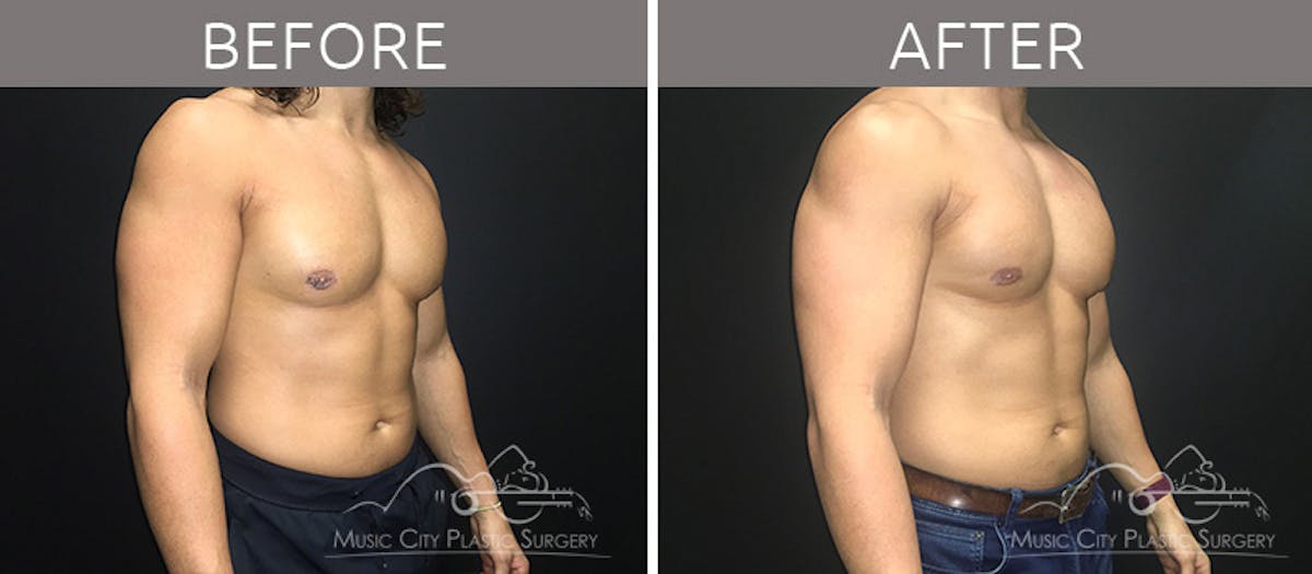 Gynecomastia Before & After Gallery - Patient 90709214 - Image 3
