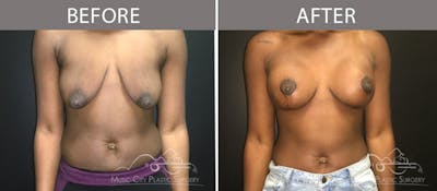 Breast Lift with Augmentation Before & After Gallery - Patient 132099620 - Image 1