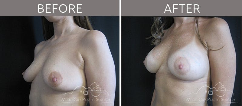 Breast Augmentation Before & After Gallery - Patient 90709217 - Image 2