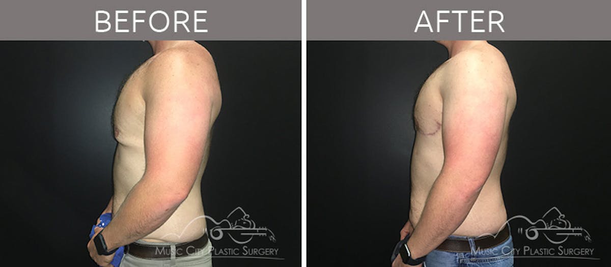 Gynecomastia Before & After Gallery - Patient 90709219 - Image 1
