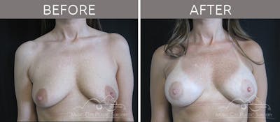 Breast Augmentation Before & After Gallery - Patient 90709217 - Image 1