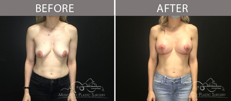 Breast Lift with Augmentation Before & After Gallery - Patient 132099611 - Image 1