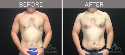 Gynecomastia Before & After Gallery - Patient 90709219 - Image 2