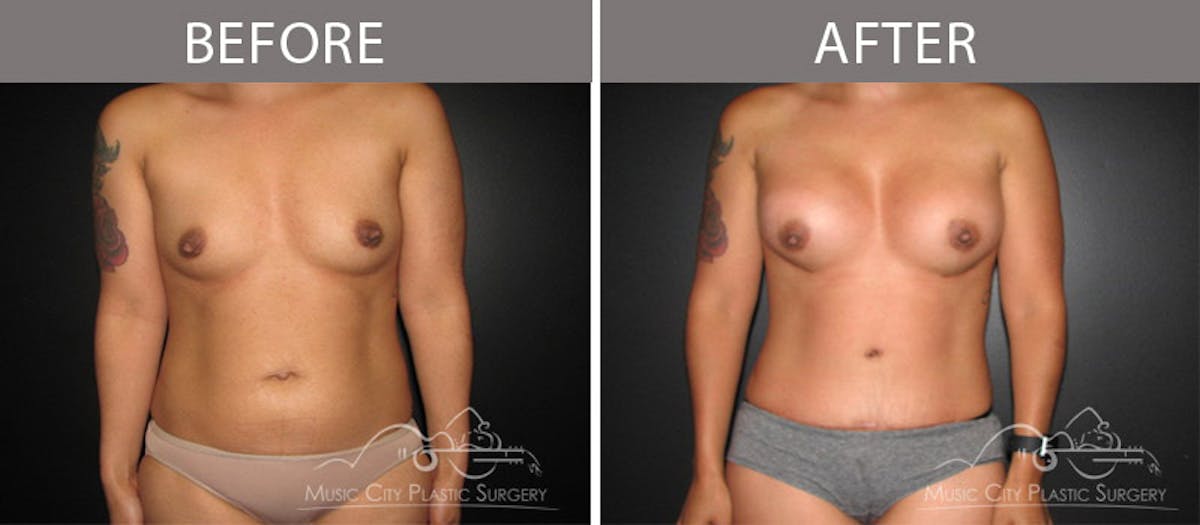 Mommy Makeover Before & After Gallery - Patient 90709218 - Image 1