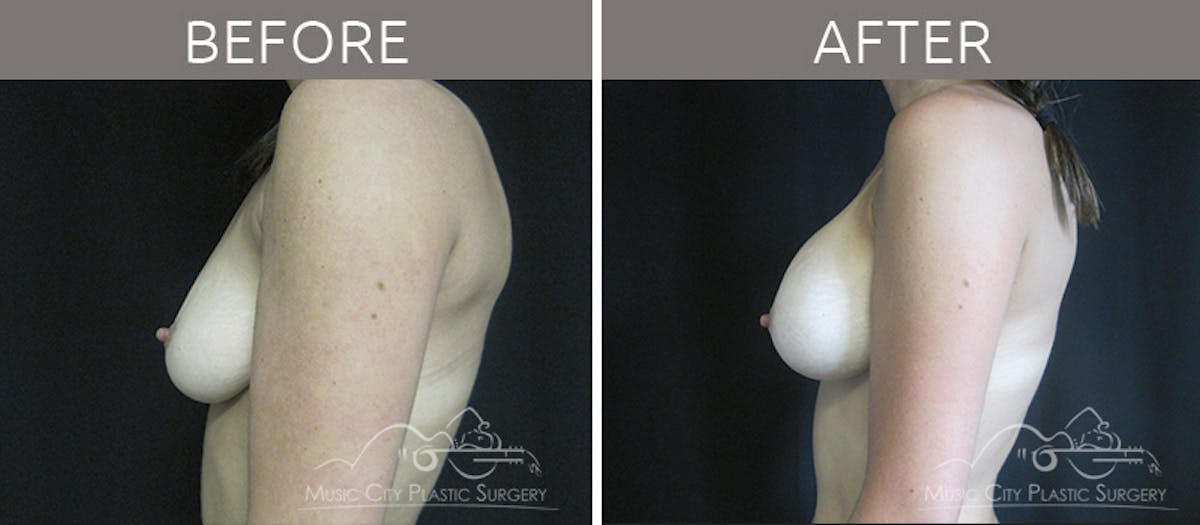 Breast Augmentation Before & After Gallery - Patient 90709231 - Image 3